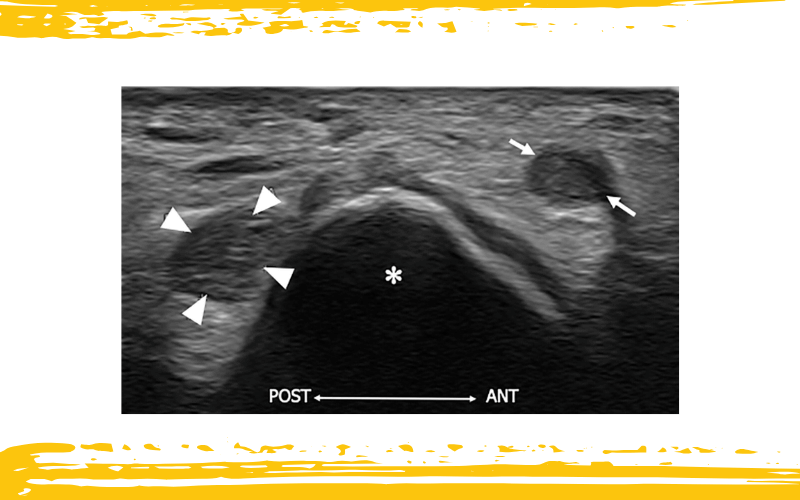 2. Nervio cutaneo medial antebrazo tempo formacion.png